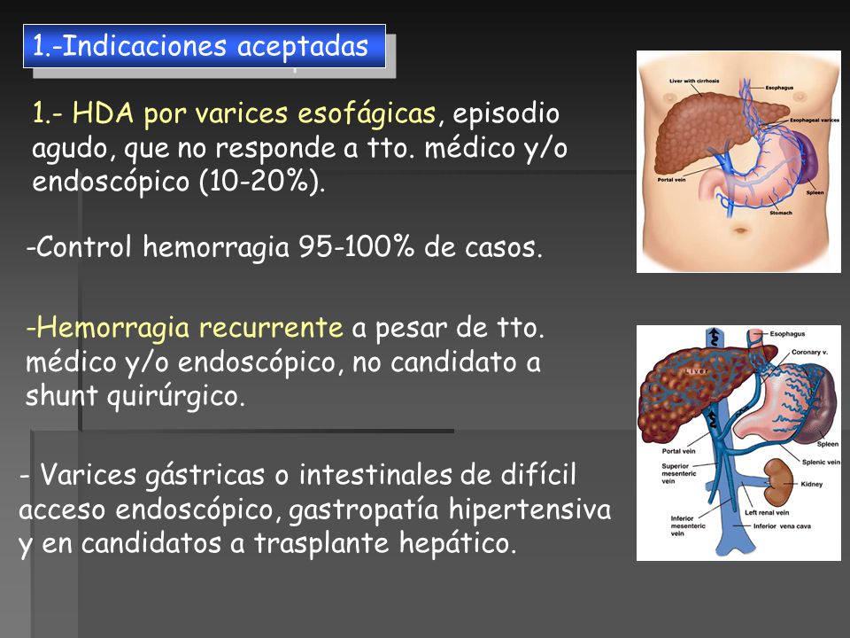 Varices estomales hipertensión portal y varices esofágicas